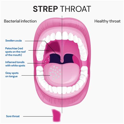 Progression Of Strep Throat