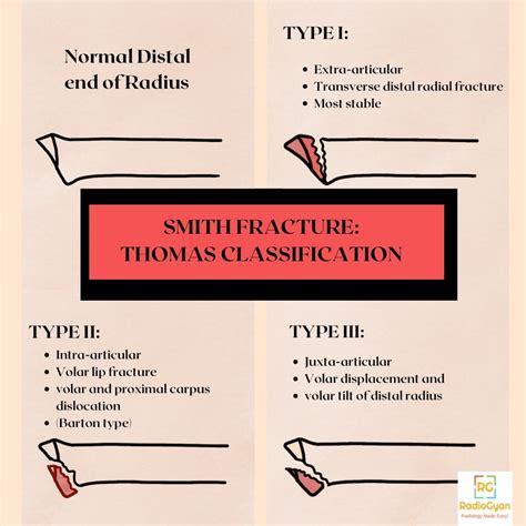 Smith Fracture - Distal Radial Fracture | Radiology Case