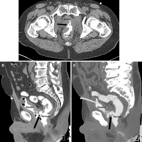 Image result for CT Cystogram vs Urogram