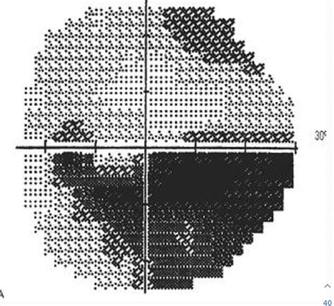 Image result for Visual Fields Red Pin