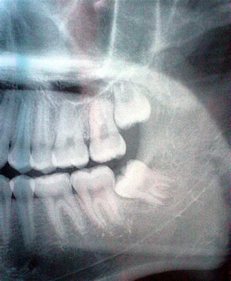儿童x光牙片图片-爱康健齿科
