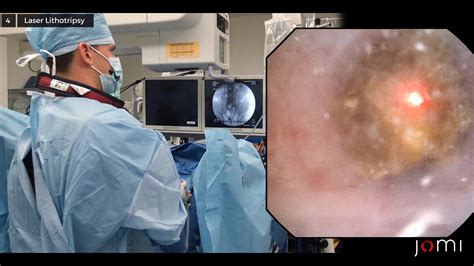 Ureteroscopy With Laser Lithotripsy