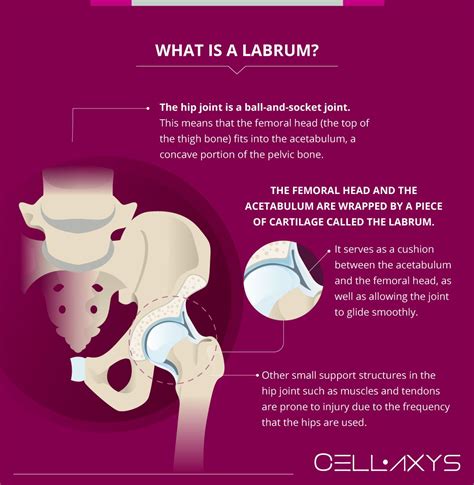 Hip labrum tears how to treat without surgery – Artofit