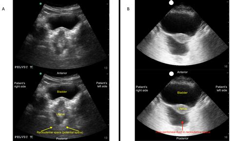 Focused Assessment with Sonography for Trauma (FAST) Exam: Image ...