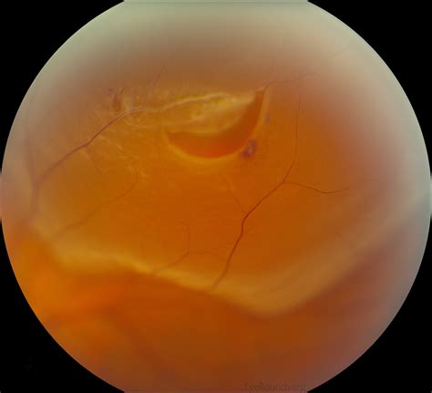 Vitreous Syneresis: An Impending Posterior Vitreous Detachment (PVD)