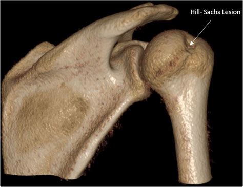 Arthroscopic-Controlled Reduction of Hill-Sachs Lesions: Treatment ...