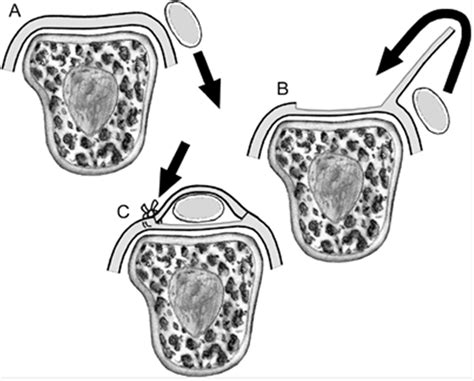 Sagittal Band Rupture - Hand - Orthobullets