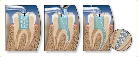 急性牙髓炎治疗有效的方法，急性牙髓炎怎么止痛 - 口腔资讯 - 牙齿矫正网