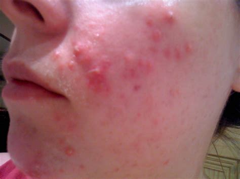 Cystic Acne | essexgirlwithpcos