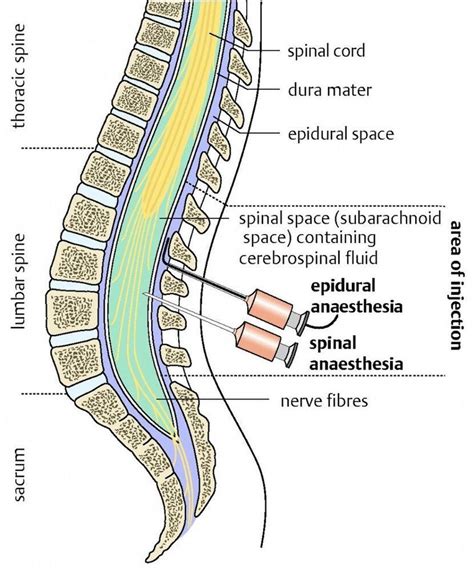 SPINAL VS EPIDURAL ANAESTHESIA - MEDizzy