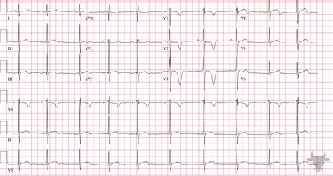 Hypertrophic Cardiomyopathy | ECG Stampede