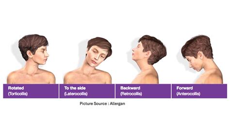 Torticollis- Wry neck – CENTRE FOR CHILD HEALTH, BLKMAX SUPER SPECIALITY HOSPITAL