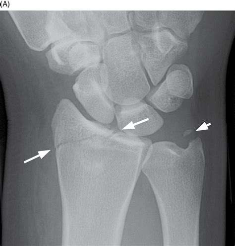 Fractured Ulna And Radius Bones