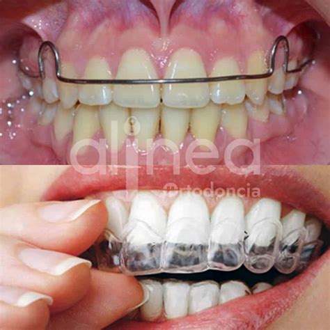 La Importancia de los Retenedores en Ortodoncia: todo lo que debes saber – Clínica Alinea Visión ...