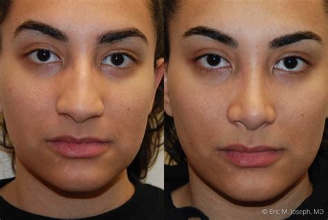 Eric M. Joseph, MD | Rhinoplasty Before & After: Nasal Hump Reduction and Narrowing
