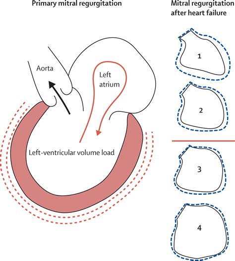 Controversies in ventricular remodelling - The Lancet