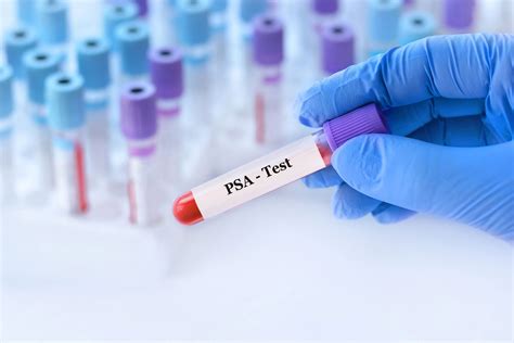 PSA Test Explained: Understanding the Prostate-Specific Antigen Test - UUA Urology