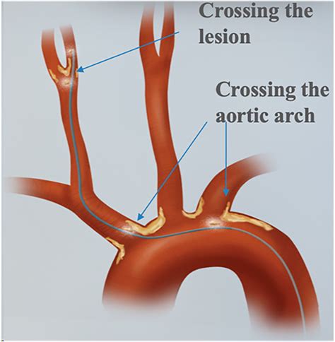 What Is the Role of Transcarotid Artery Revascularization? - Advances in Surgery
