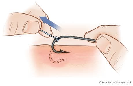 Image result for String Pull Method Fish Hook Removal