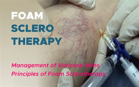 Foam Sclerotherapy: Management of Varicose Veins | SurgMedia