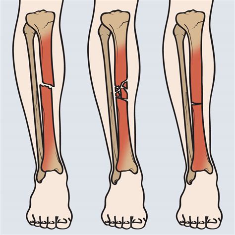 Tibia Wedge Fracture at Stephanie Cooke blog