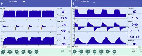 Airway pressure release ventilation - BJA Education