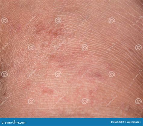 Dry Cracking Skin in the Winter Stock Photo - Image of feature, water ...