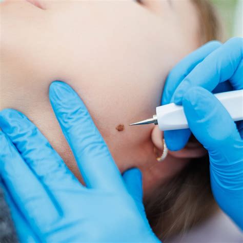 Laser Age Spot Removal St. Paul, MN / Roseville, MN