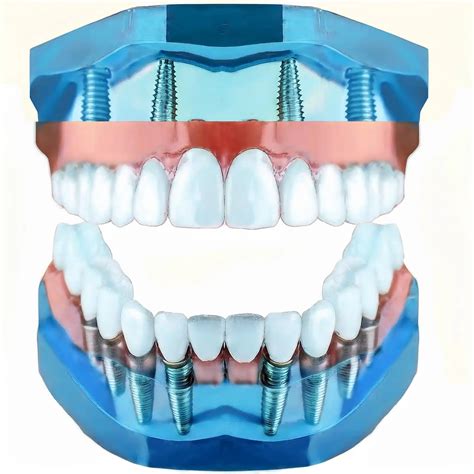 ¿Cuánto duran los implantes dentales?