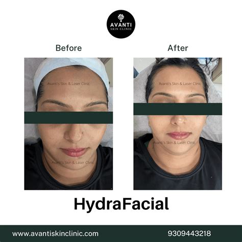 Why Do You Get Forehead Pimples? Causes & Treatments