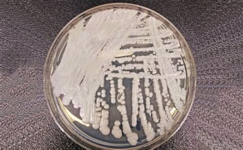 致死率60%! 美国多地爆发超级真菌被列为“紧急威胁” 中国确诊18例感染-第一黄金网