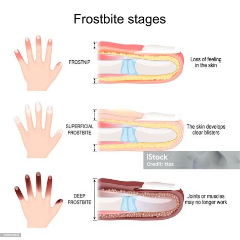 Frostbite Stages Of Fingers Stock Illustration - Download Image Now ...