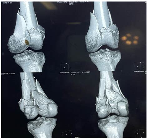 IJOS - Indian J Orthop Surg