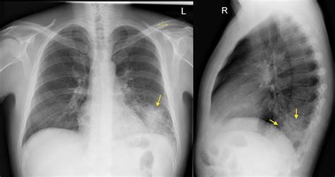 Left Lateral Chest X Ray Chest Radiograph