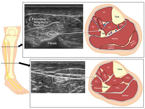 Sonographic Evaluation of Superficial Peroneal Nerve Abnormalities | AJR