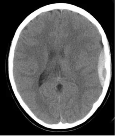 Uncal Herniation Brain Herniation Syndrome Uncal