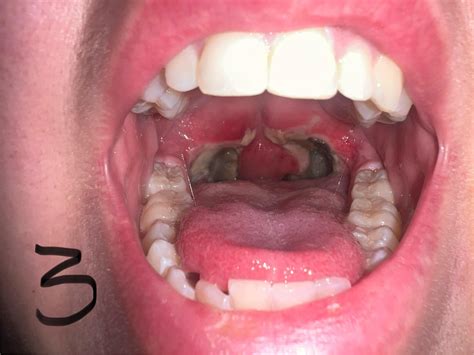 Tonsillectomy Recovery (with pictures) : r/tonsilstones