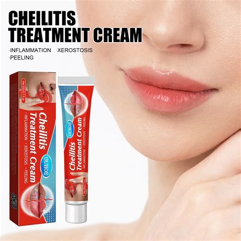 OUHOE Cheilitis Treatment Cream 20g Labial Herpes Antibacterial Ointment Chapped Peeling ...