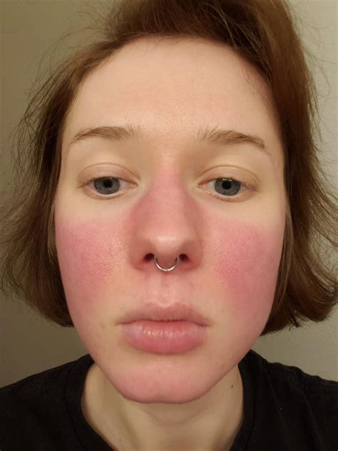 Rash On Face Around Nose Area Shingles Rash On The Face Stock Image