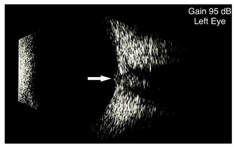 Optic Nerve Ultrasound Evaluation in Children: A Review