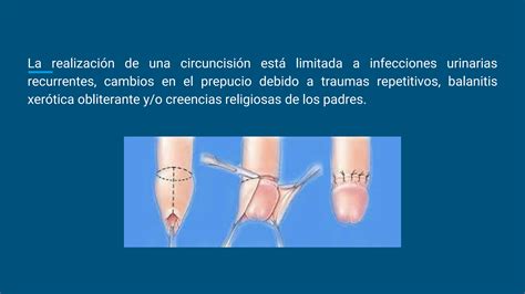 Operación De Fimosis: Síntomas, Procedimiento Y Recuperación – SXEYQX