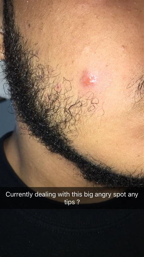 Image result for Worst Exploding Pimple