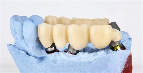 How Does a Dental Bridge Work? Key Benefits & Process