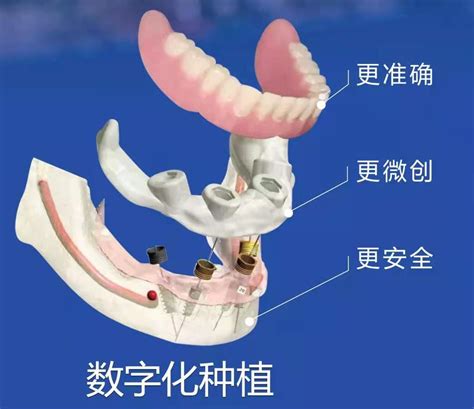 柏德口腔德国四大种植牙系列，现场直播种牙过程 - 企业 - 中国产业经济信息网