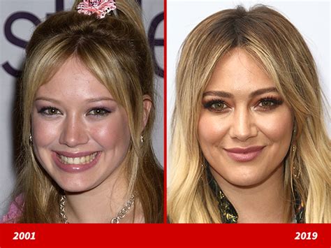 Hilary Duff Face Surgery