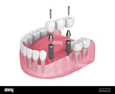 3d render of jaw with dental bridge supported by implants in jaw over white background Stock ...