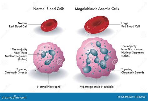 Blood Cells with Megaloblastic Anemia Stock Vector - Illustration of ...