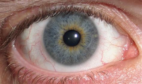 File:Eye Central Heterochromia crop and lighter.jpg - Wikipedia