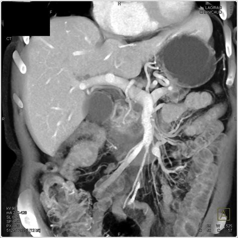 Pancreas Adenocarcinoma with Dilated Pancreatic Duct - Pancreas ...