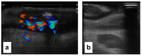 Use of Intraoperative Ultrasonography of the Small Bowel to Reduce ...